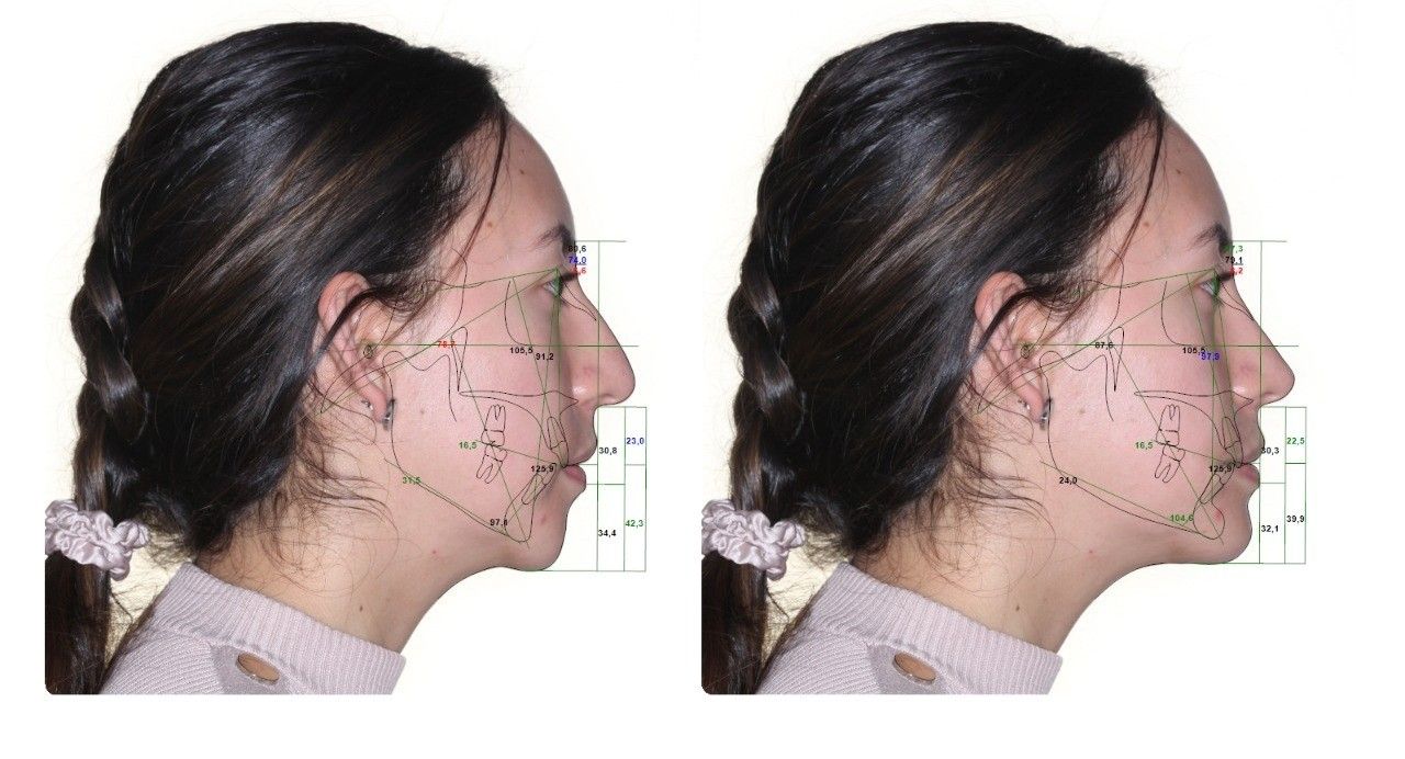 Rhinoplasty before and after, case #0001
