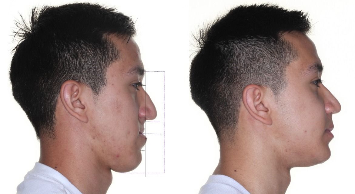 Rhinoplasty before and after, case #0002