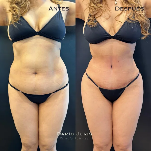 Antes y después de Rinoplastia, caso #0001
