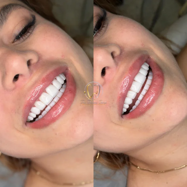 Tummy tuck before and after, case #0001